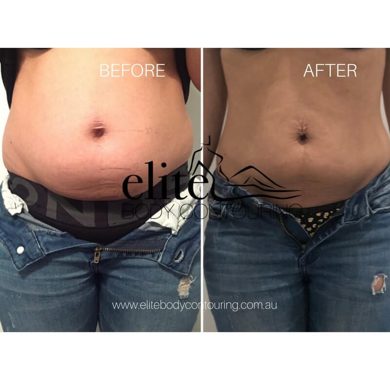 Client Results Elite Body Contouring Before And After