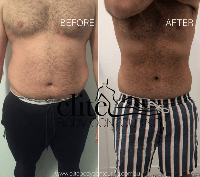 Client Results - Elite Body Contouring | Before And After Fat Freezing