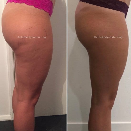 Non Surgical Butt Lift Brazilian Elite Body Contouring