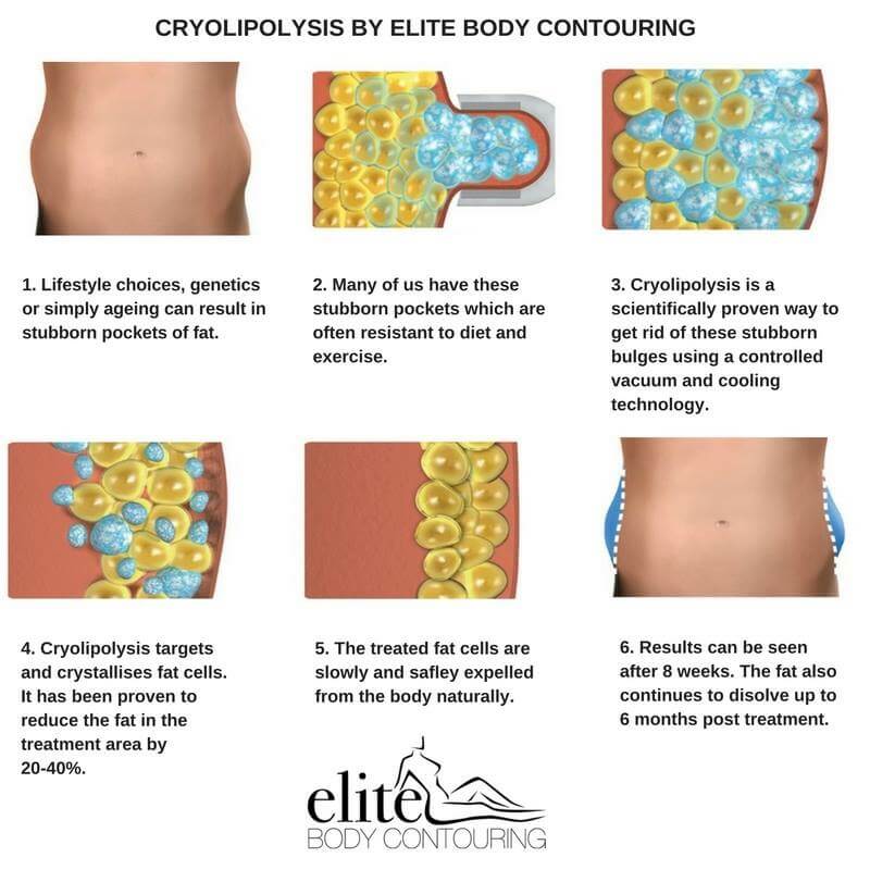 Cryo Fat Freezing