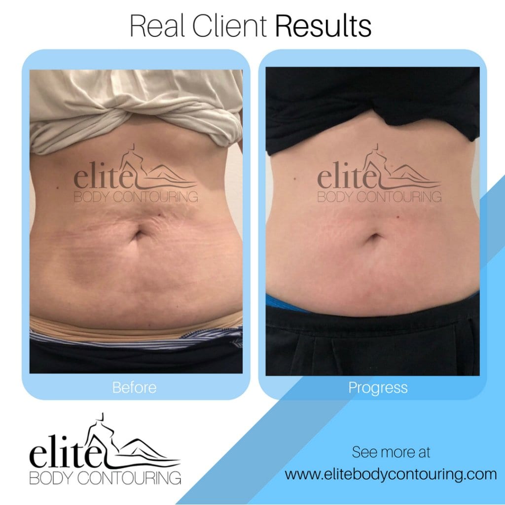 Client Results - Elite Body Contouring | Before and After Fat Freezing