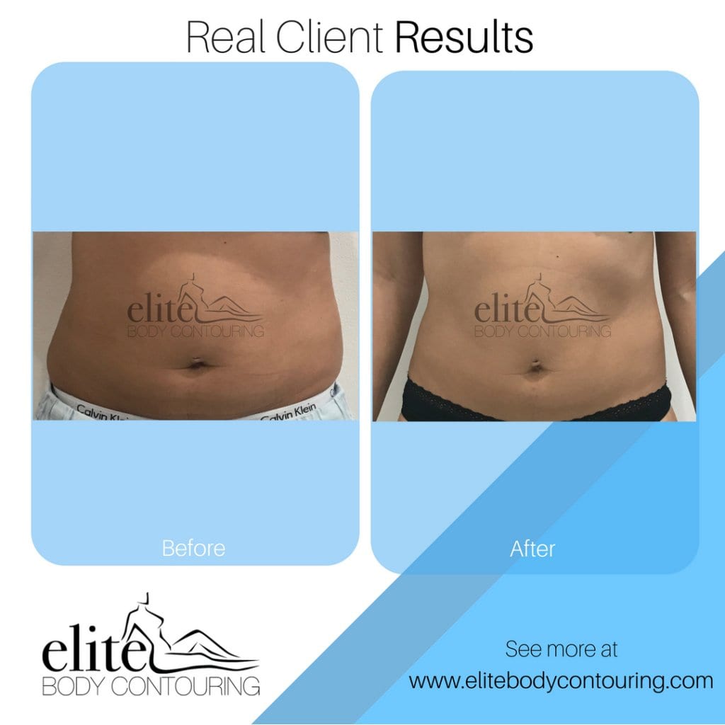 Client Results Elite Body Contouring Before And After Fat Freezing