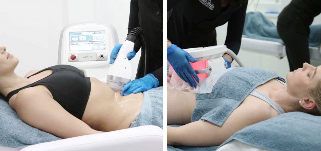 difference between LIPOcel and Cryolipolysis