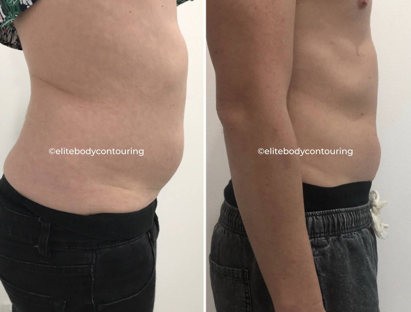 CRYOLIPOLYSIS UPPER AND LOWER AB