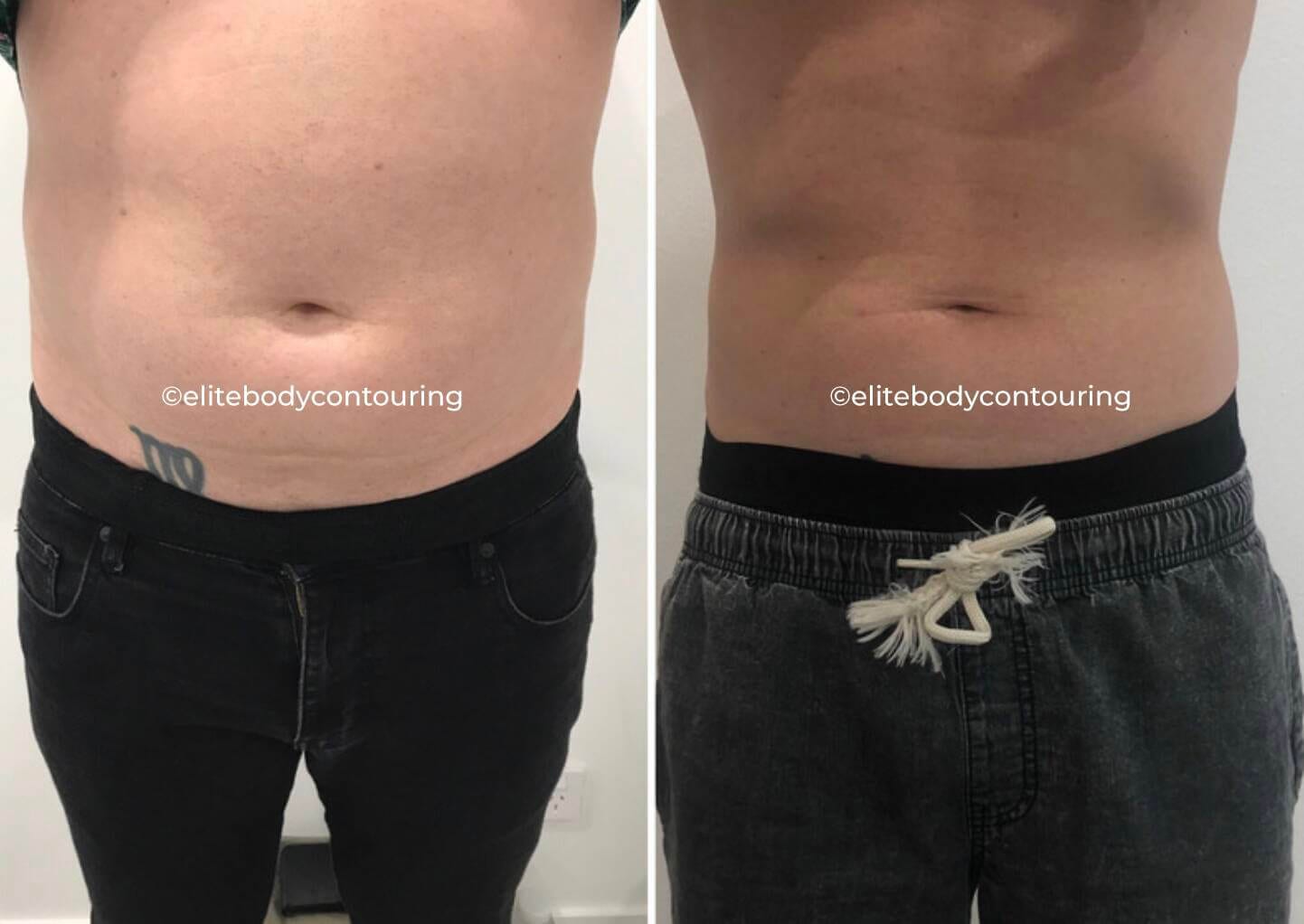 CRYOLIPOLYSIS UPPER AND LOWER AB1