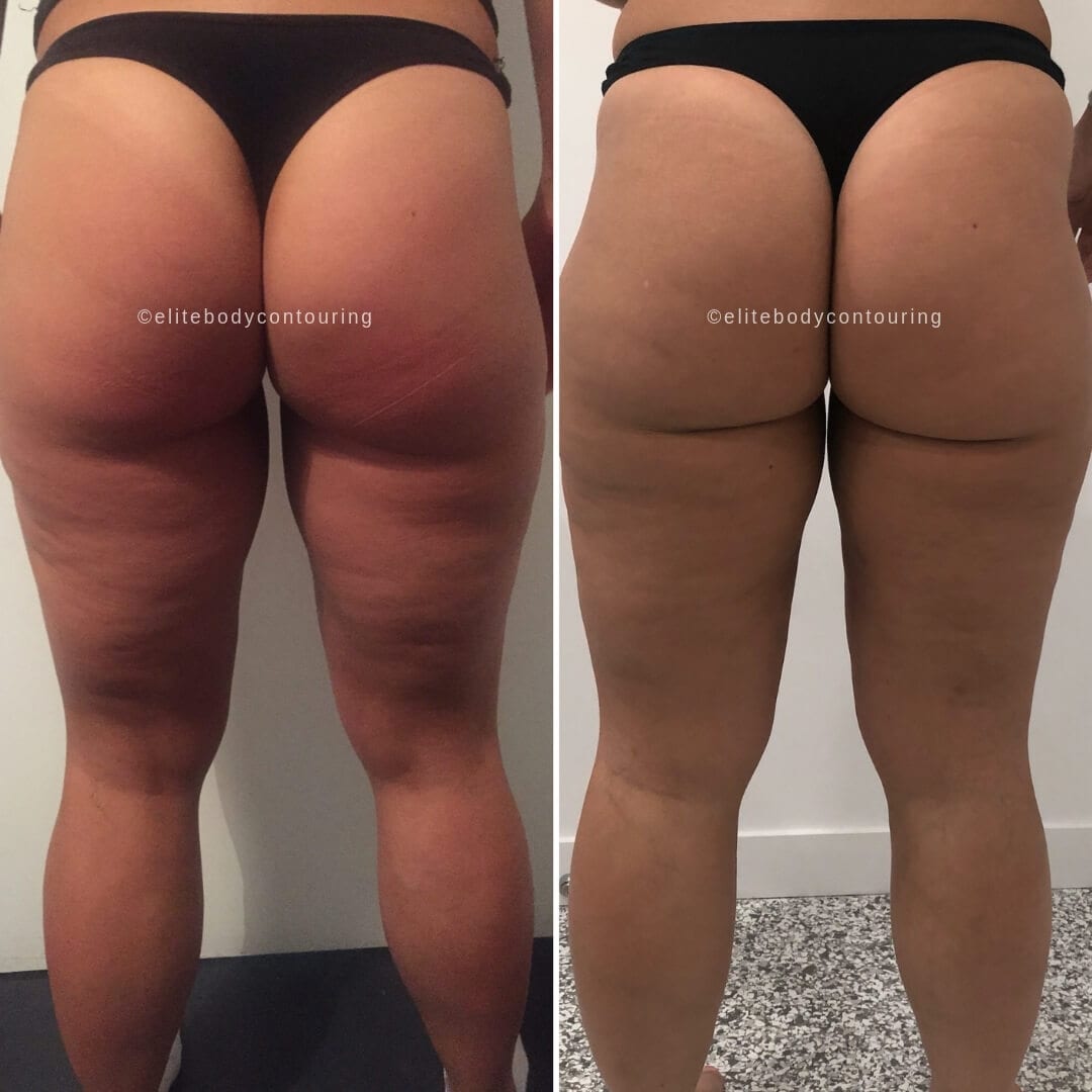 Cellulite Results