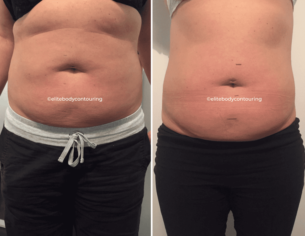 Fat Reduction Treatments | Sydney | Elite Body Contouring