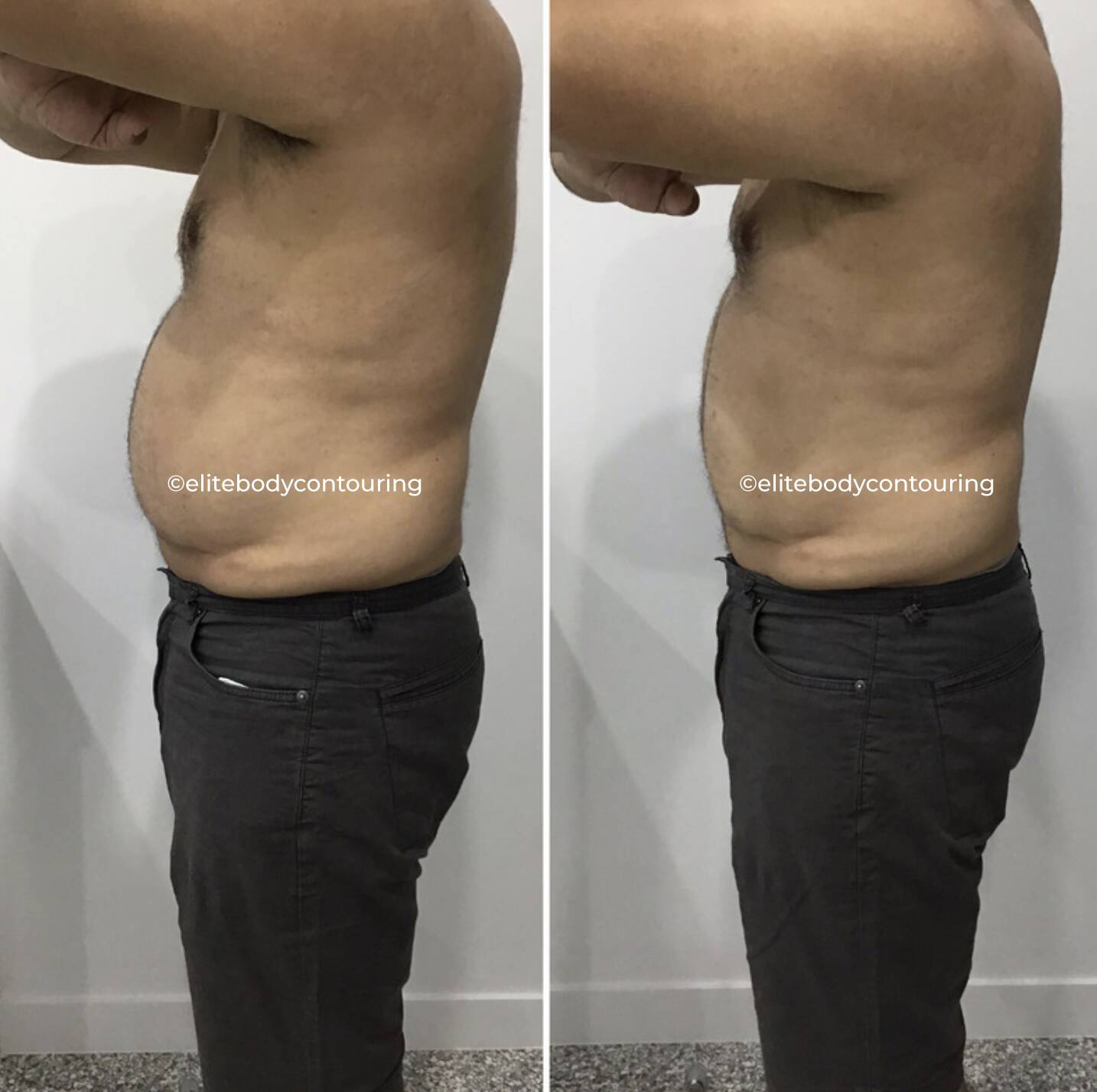 LIPOcel Body Sculpting Sydney Skin Tightening & Fat Loss Treatment