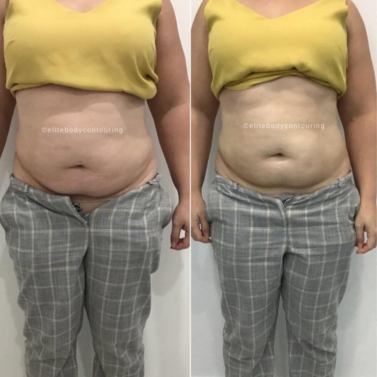 LIPOcel Reviews & Results NonSurgical Fat Reduction Treatment