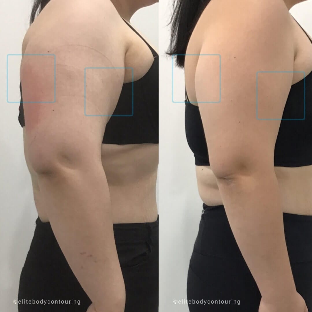 ARMS Cryolipolysis