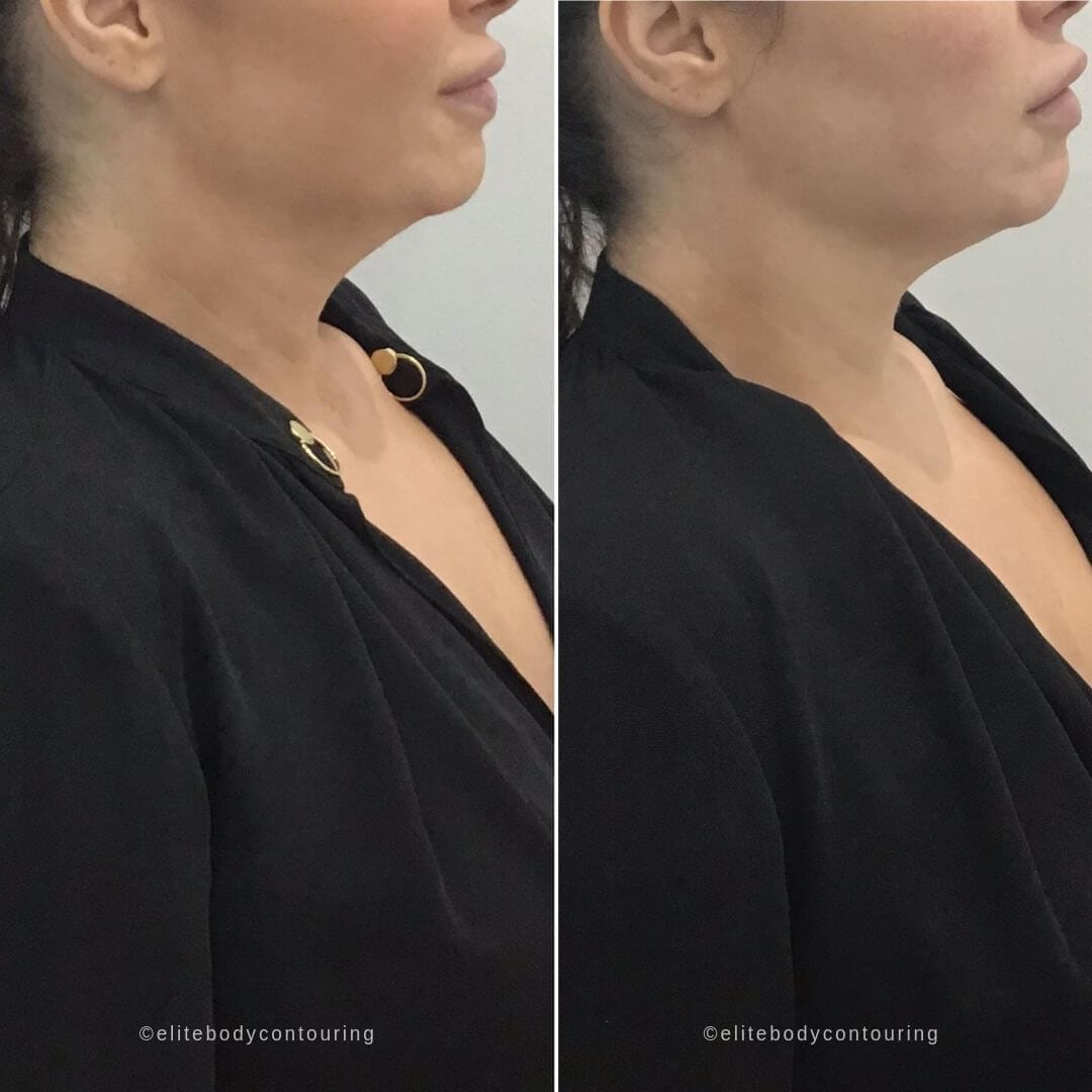 Chin Sculpting Elite Body Contouring