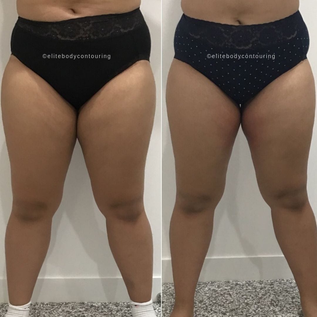Cryolipolysis fat freezing inner thighs