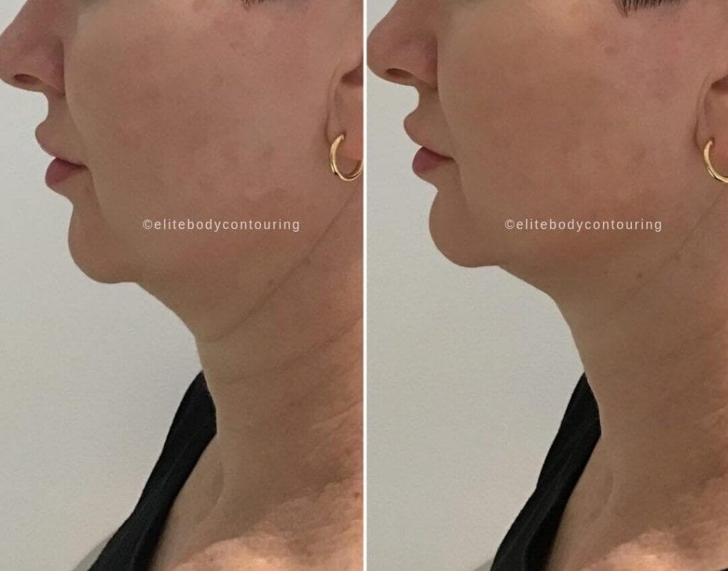 Chin Sculpting Reviews Elite Body Contouring