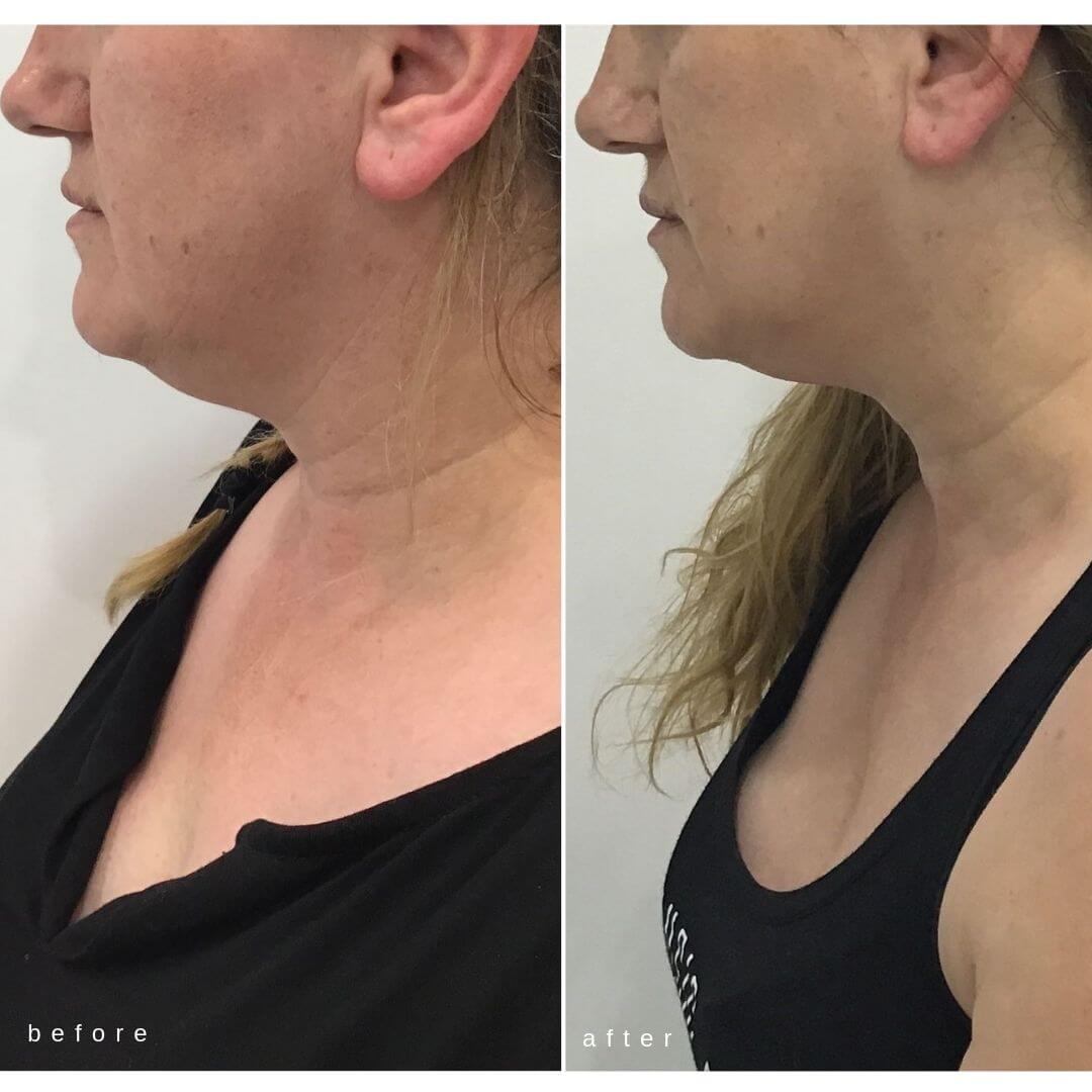 Chin Sculpting Elite Body Contouring