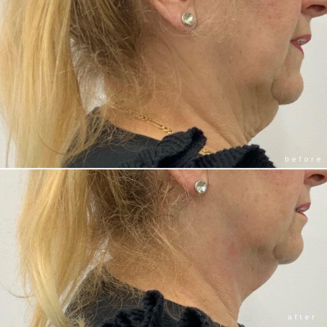 Chin Sculpting Elite Body Contouring