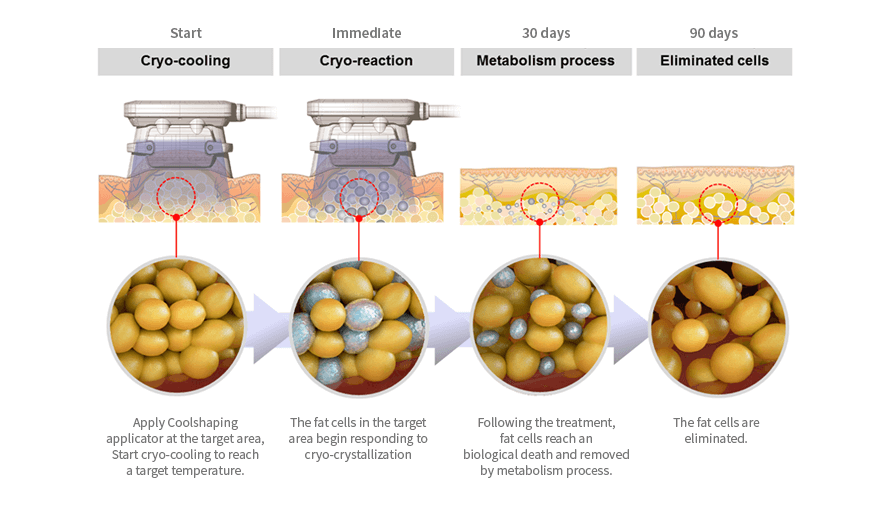 Does Fat Freezing Work? Your Guide To Cryolipolis Fat Reduction