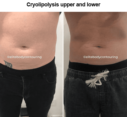 Cryolipolysis_upper_and_lower