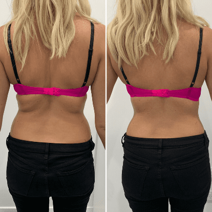 Before and After Fat Burning with LIPOcel Body Sculpting