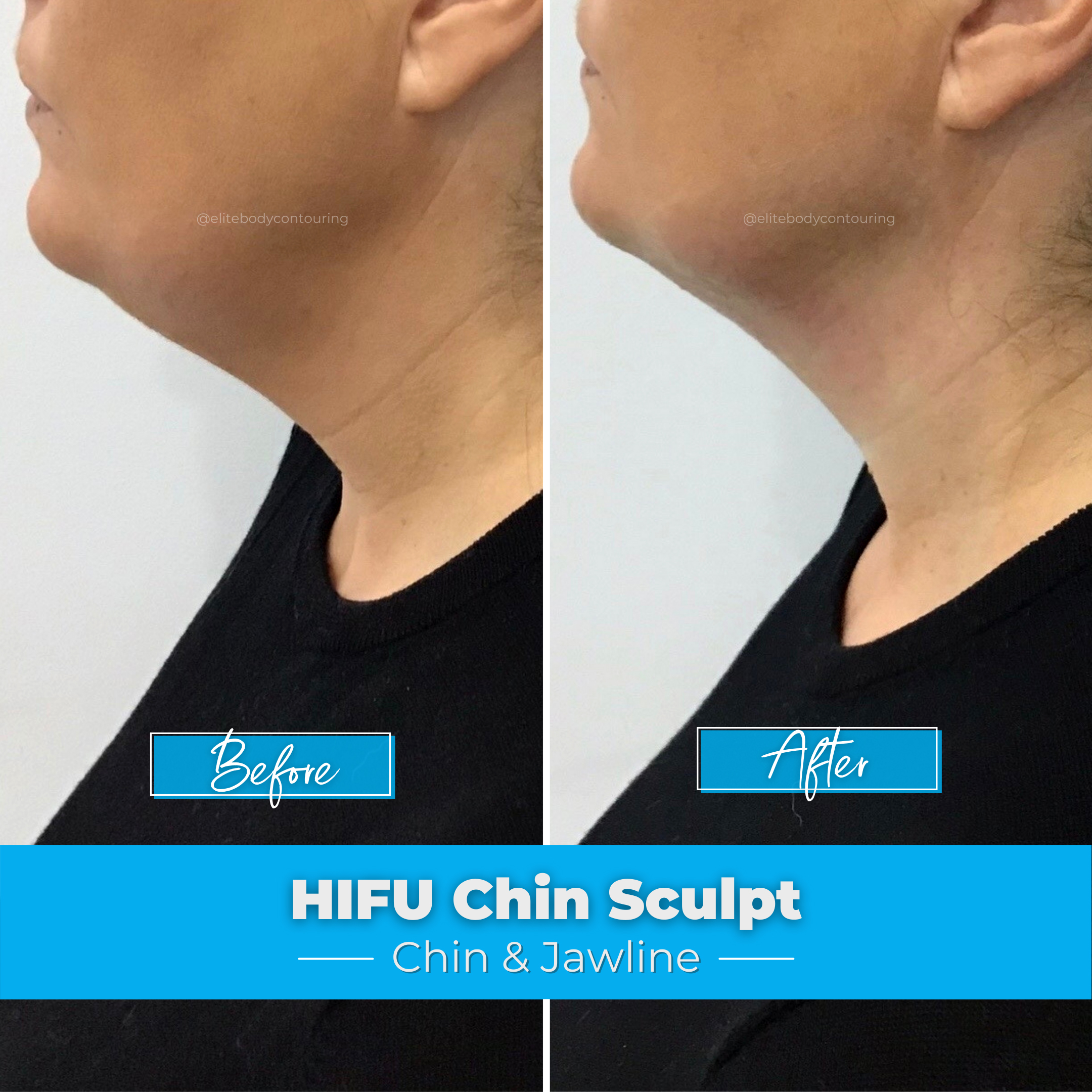 Chin Sculpting | HIFU | Double Chin | Elite Body Contouring