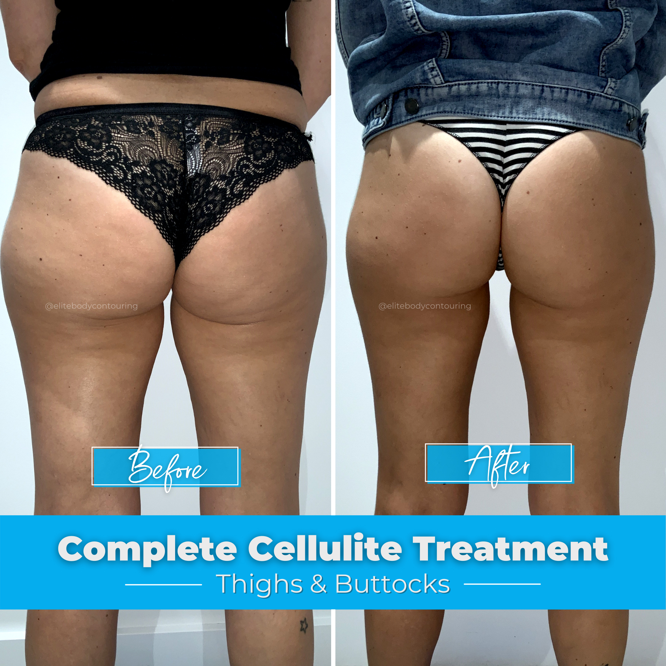 Cellulite Treatment - Thighs & Buttocks