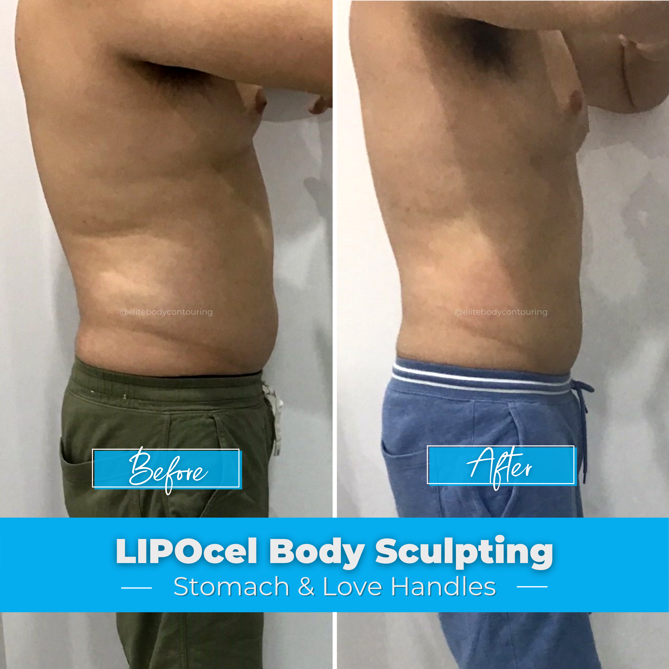 LIPOcel Body Sculpting - Stomach