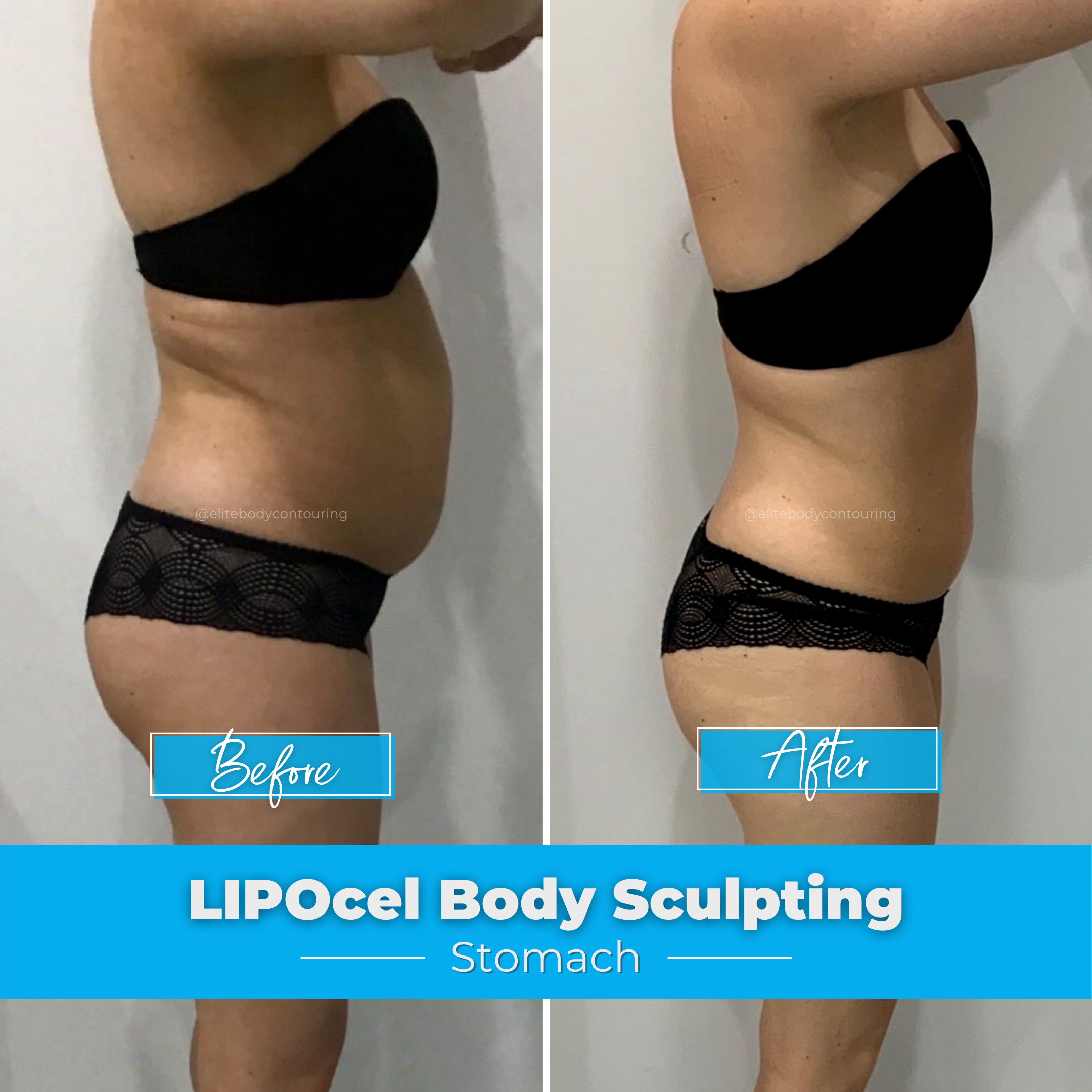 LIPOcel Body Sculpting - Stomach
