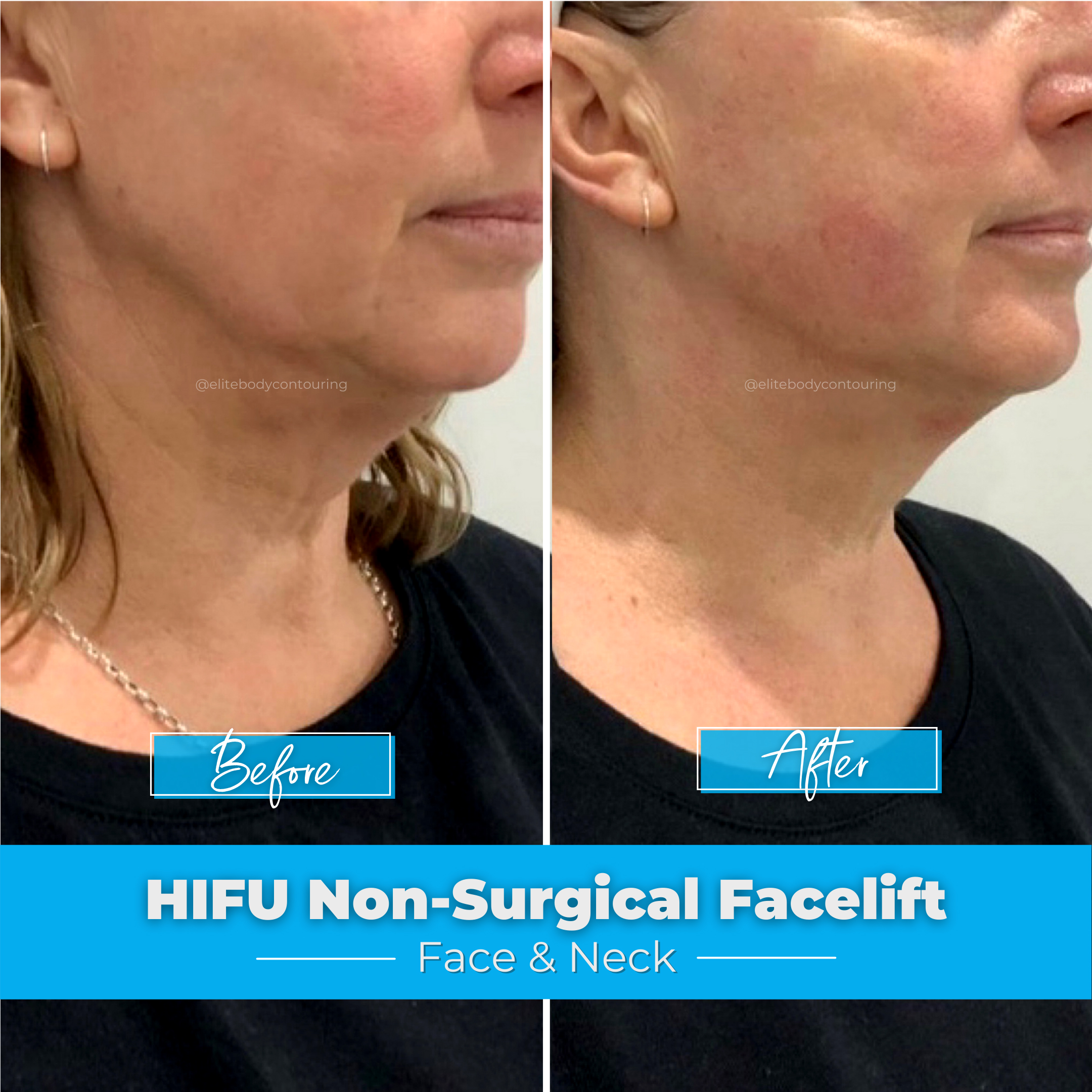 HIFU Non-Surgical Facelift