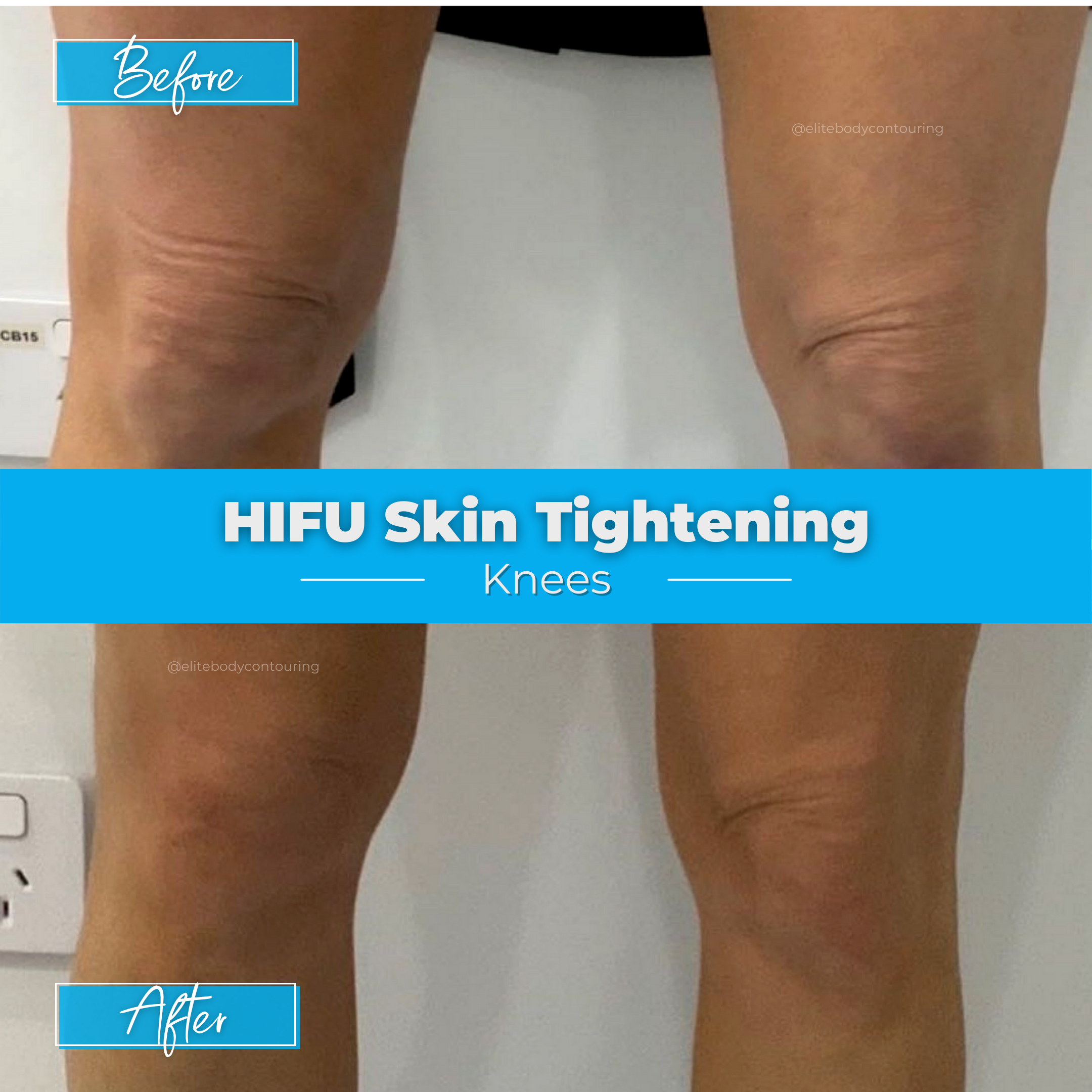 HIFU Skin Tightening - Knees