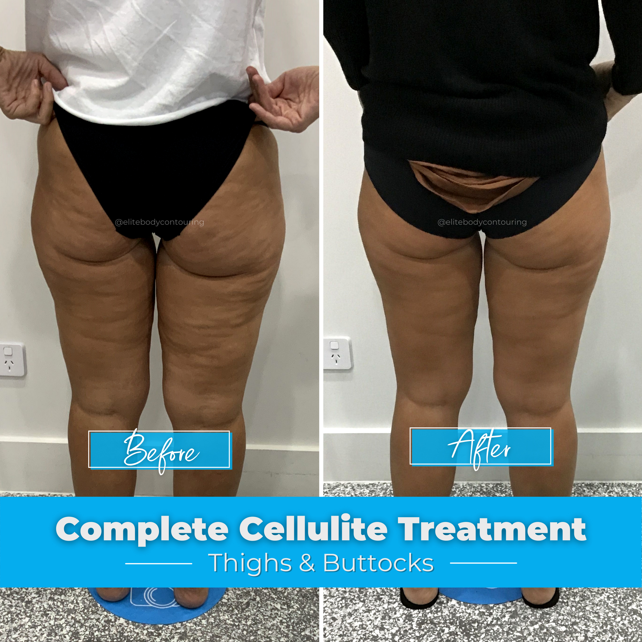 Complete Cellulite Treatment Elite Body Contouring