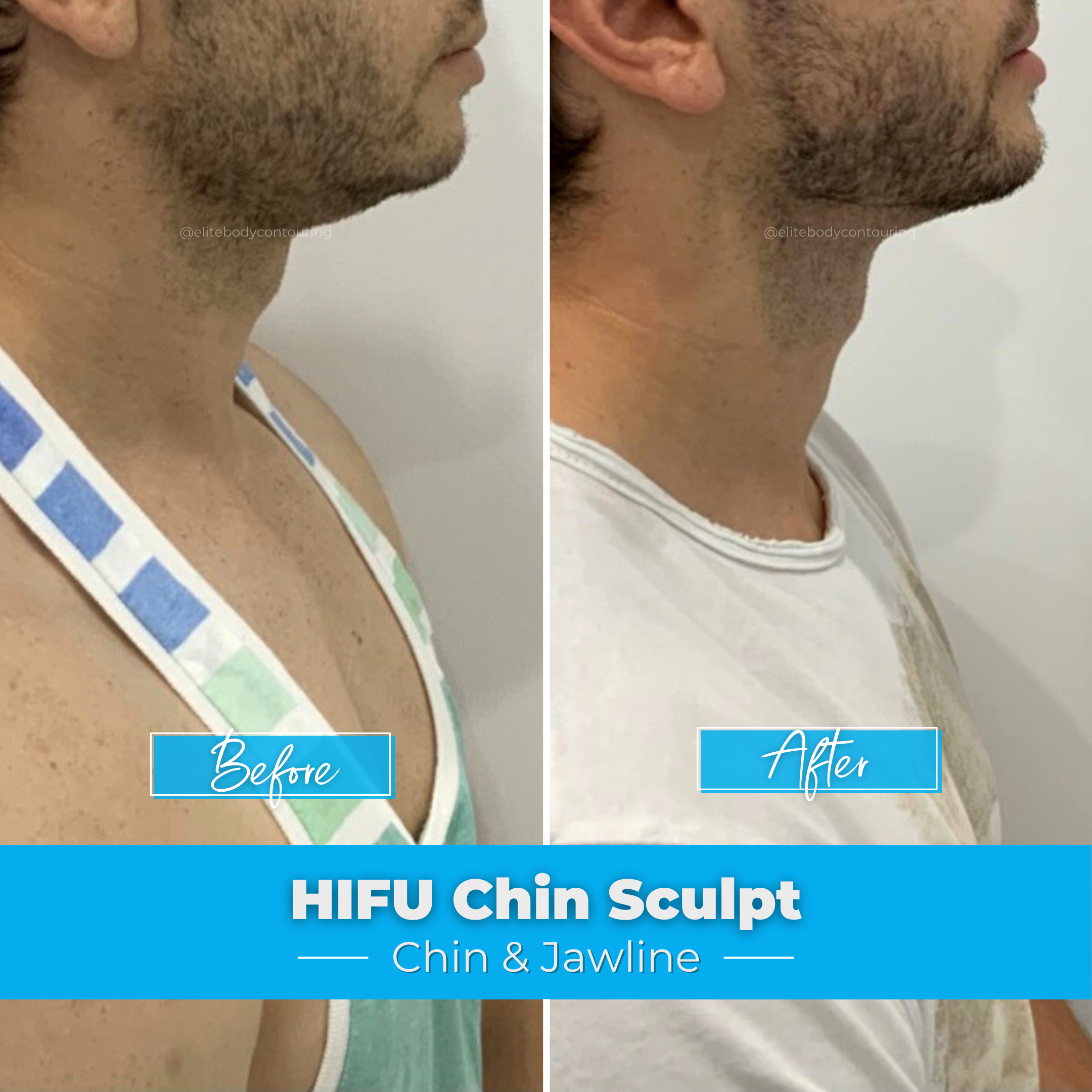 Chin Sculpting | HIFU | Double Chin | Elite Body Contouring