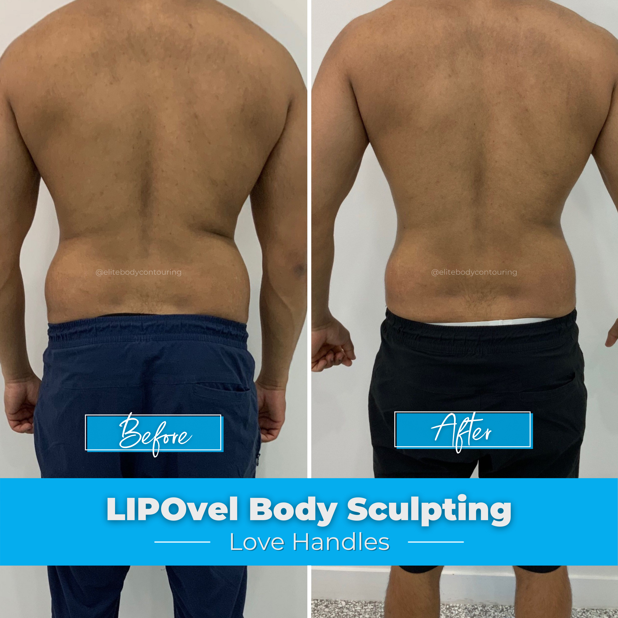 LIPOcel Body Sculpting Results Elite Body Contouring