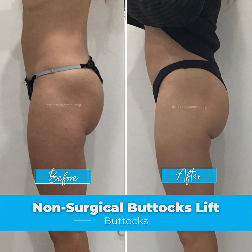 Bon-Surgical-Buttocks-Lift_Buttocks