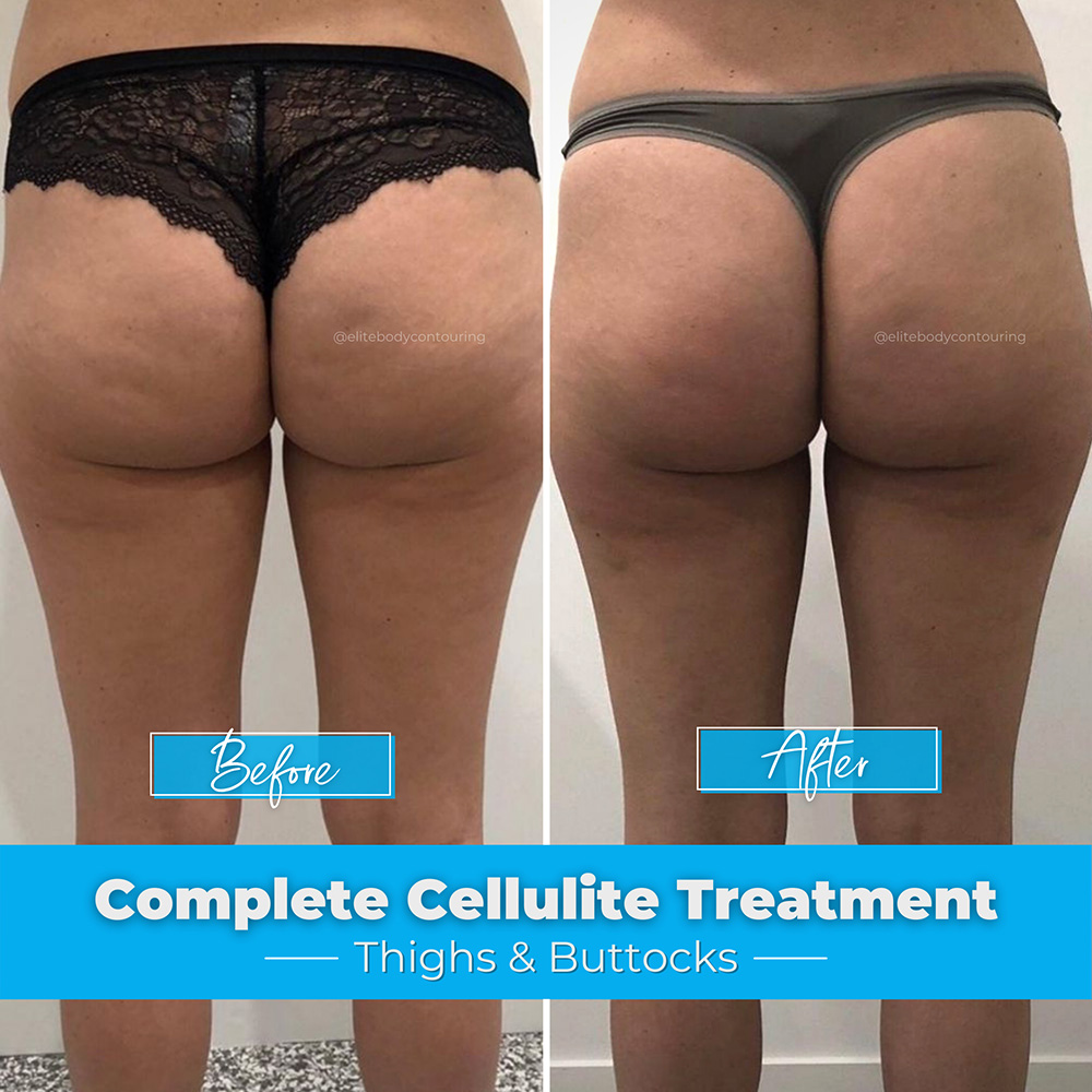 Complete-Cellulite-Treatment_Thighs-&-Buttocks
