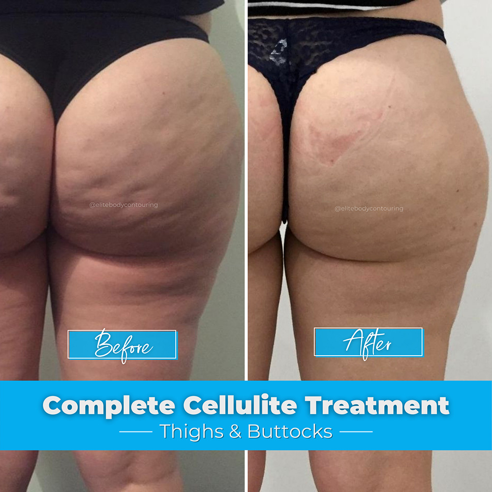 Complete-Cellulite-Treatment_Thighs-&-Buttocks2