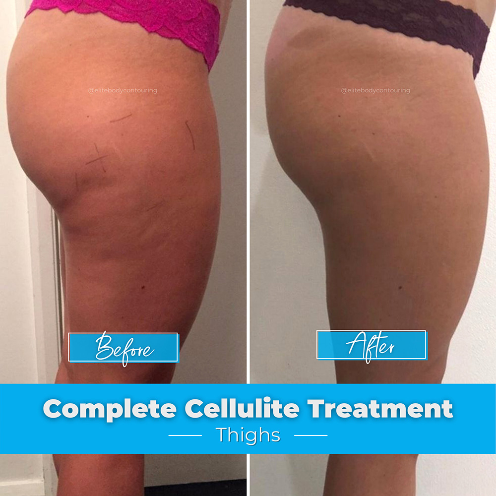 Complete-Cellulite-Treatment_Thighs4