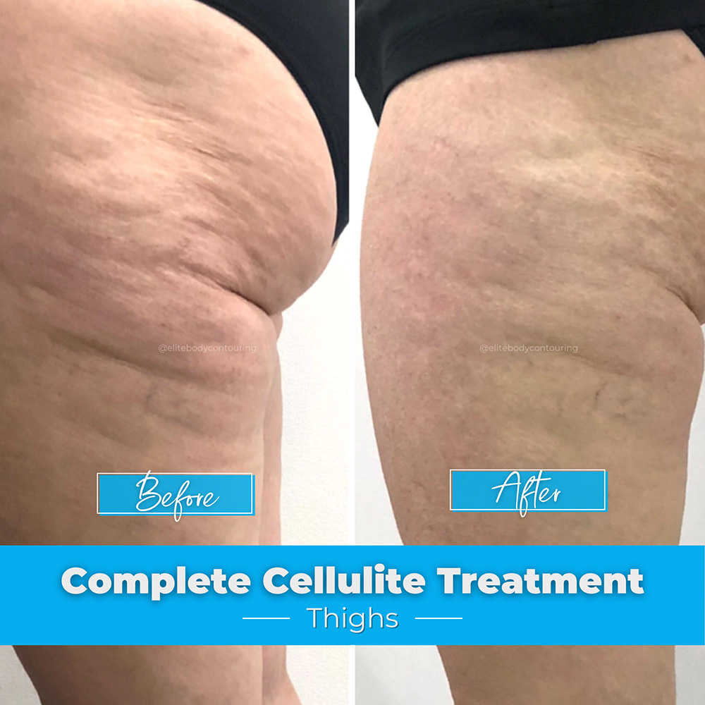Remove cellulite from thighs