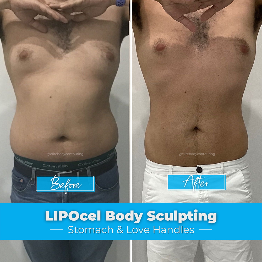 LIPOcel-Body-Sculpting_Stomach-&-Love-Handles2