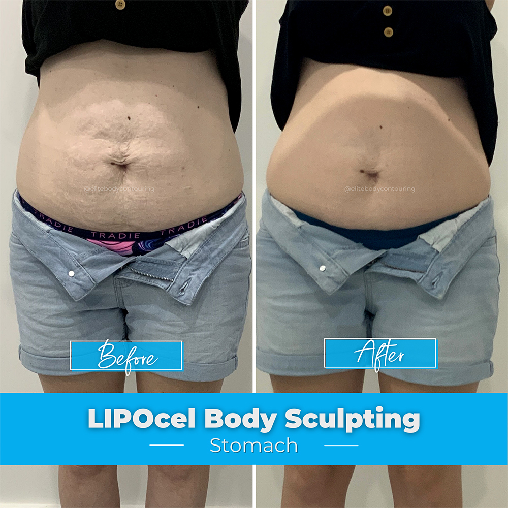 LIPOcel Body Sculpting Results Elite Body Contouring
