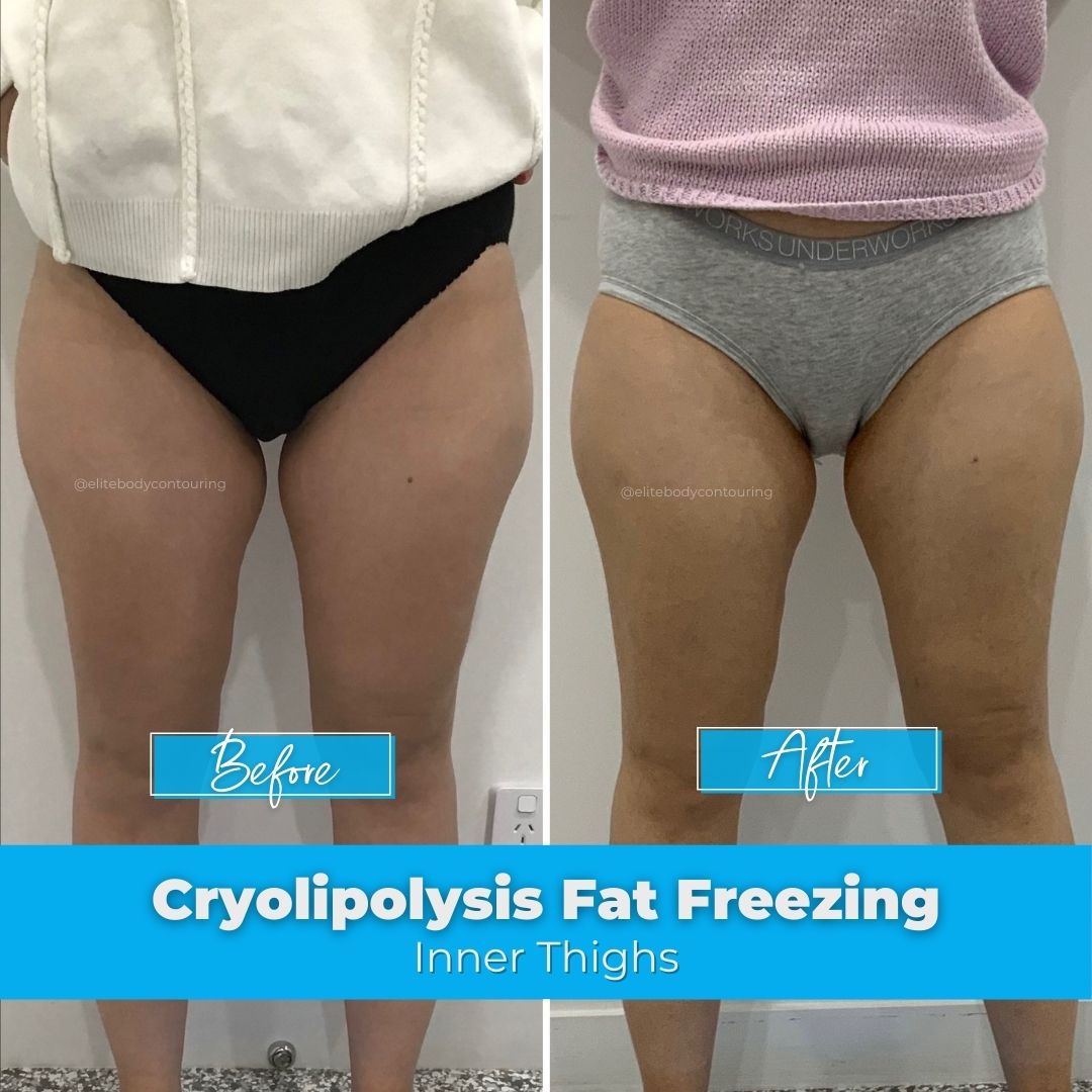 Fat Freezing on the Thighs Before & After Client Results at Elite Body Contouring