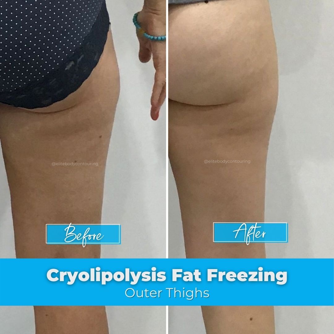 01. Fat Freezing - Outer Thighs