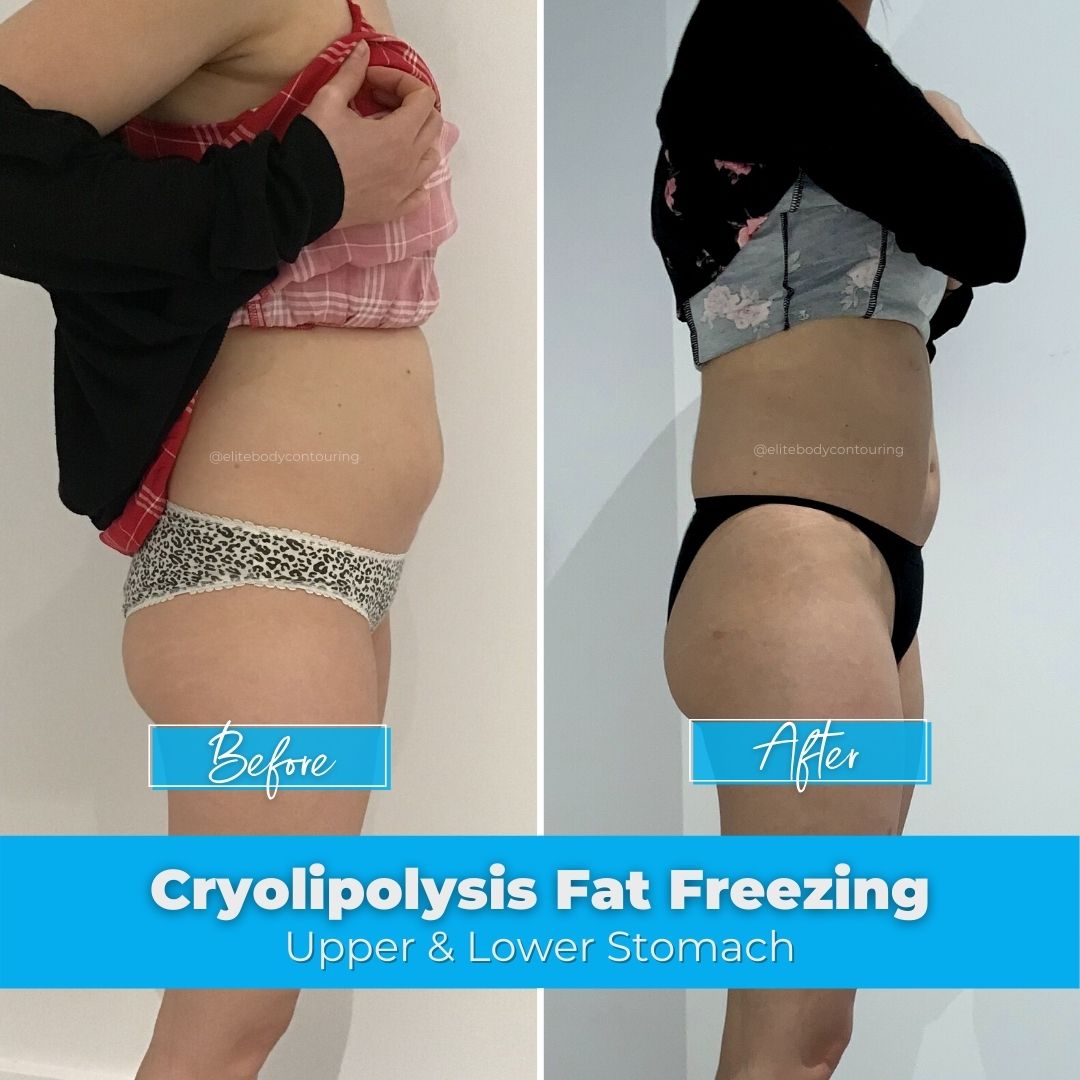 01. Fat Freezing - Upper & Lower Stomach