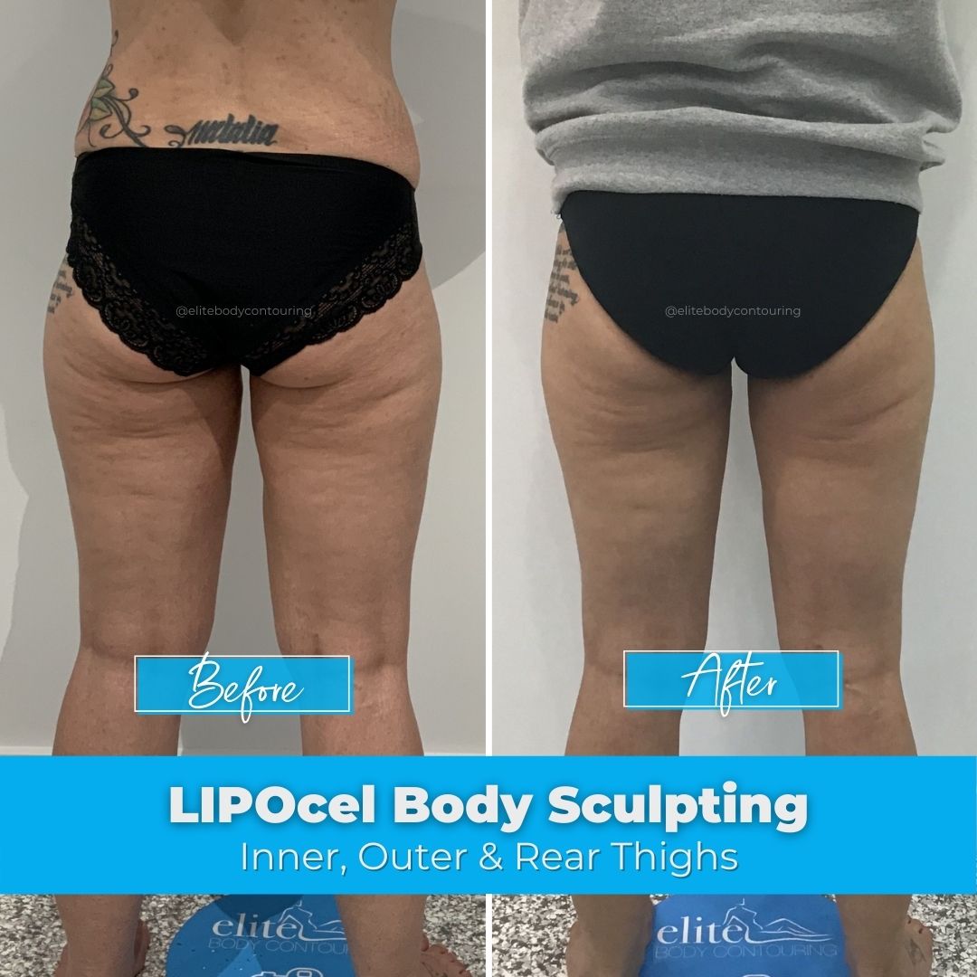 01. LIPOcel Body Sculpting - Inner, Outer & Rear Thighs