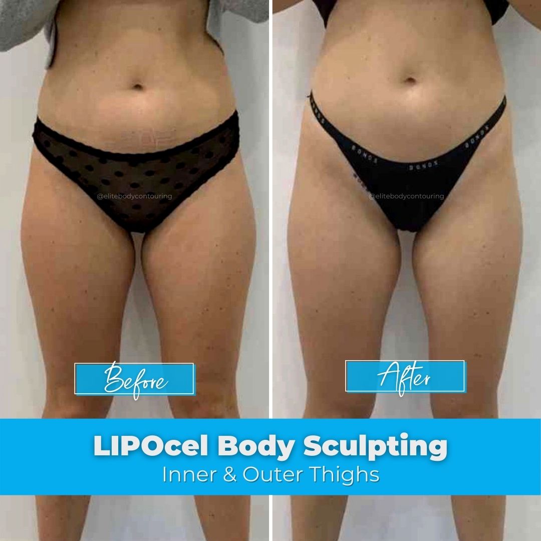 01. LIPOcel Body Sculpting - Inner & Outer Thighs