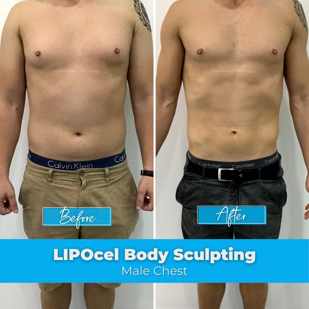 LIPOcel Body Sculpting HIFU Elite Body Contouring