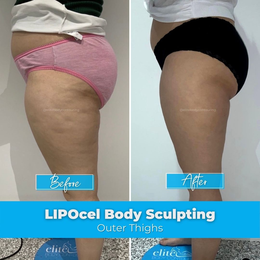 01. LIPOcel Body Sculpting - Outer Thighs