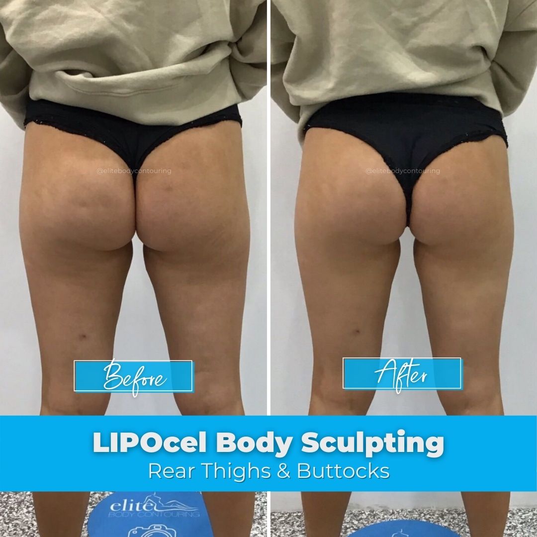 01. LIPOcel Body Sculpting - Rear Thighs & Buttocks