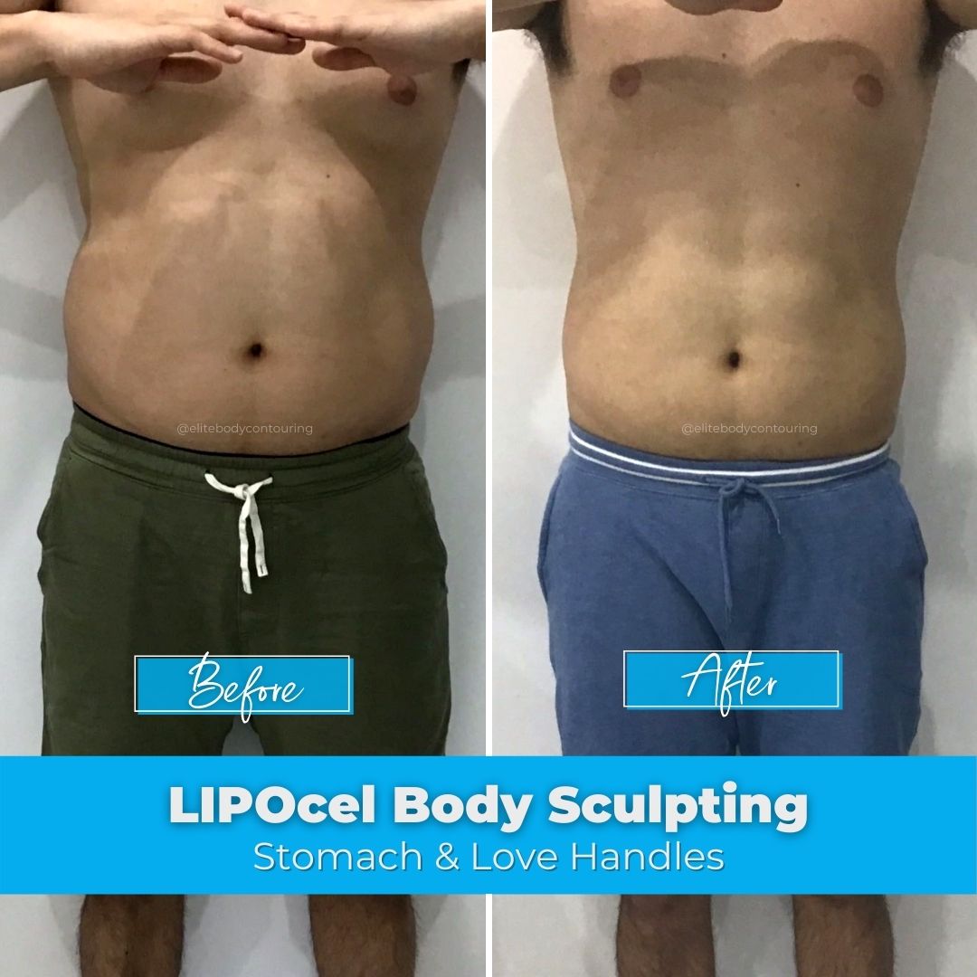01. LIPOcel Body Sculpting - Stomach & Love Handles
