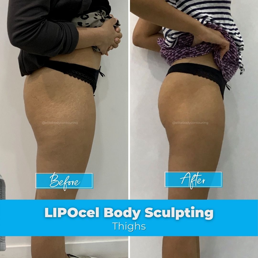 01. LIPOcel Body Sculpting - Thighs