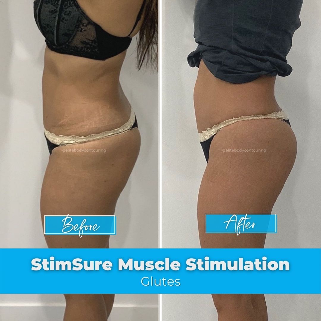01. StimSure Muscle Stimulation - Glutes