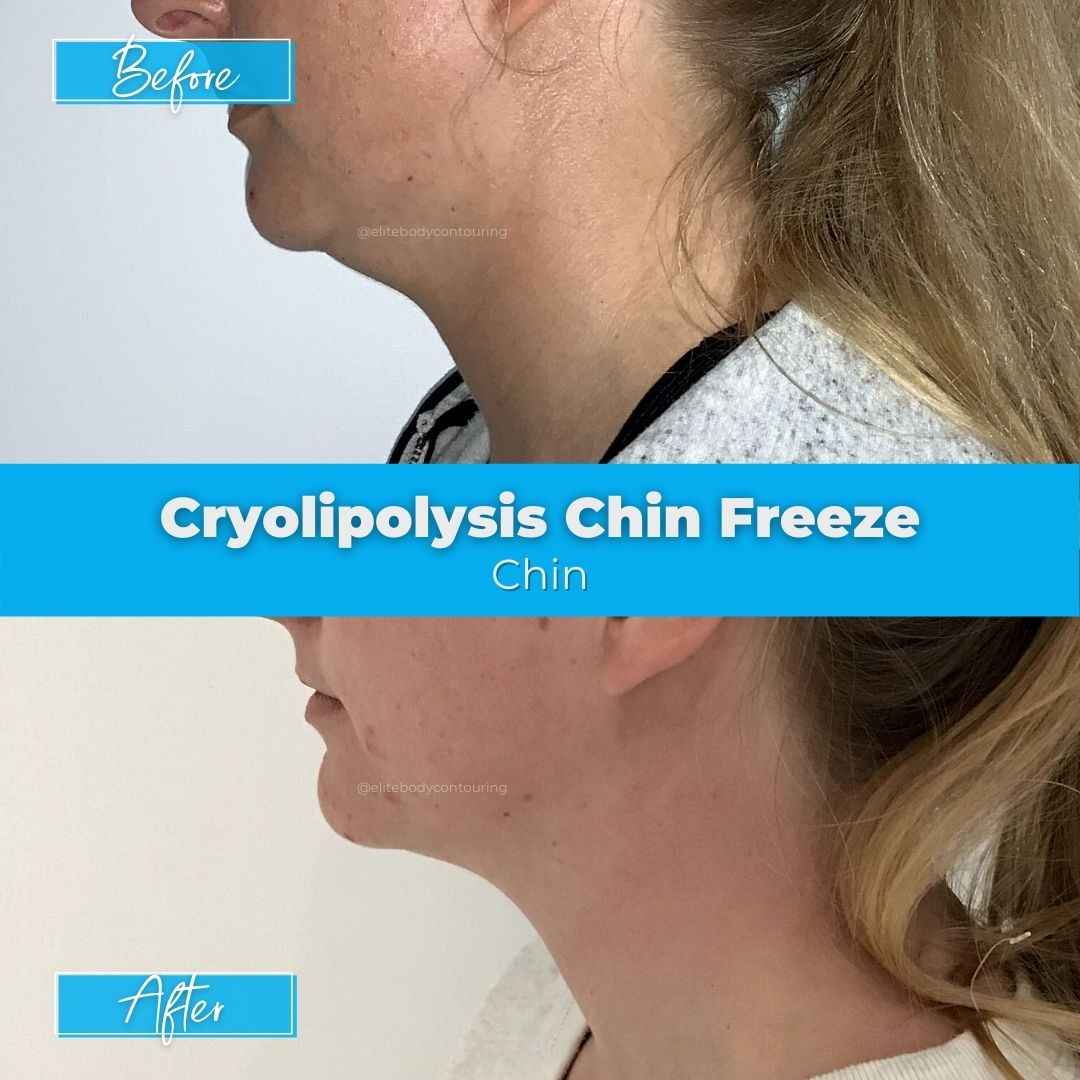 02. Cryolipolysis Chin Freeze